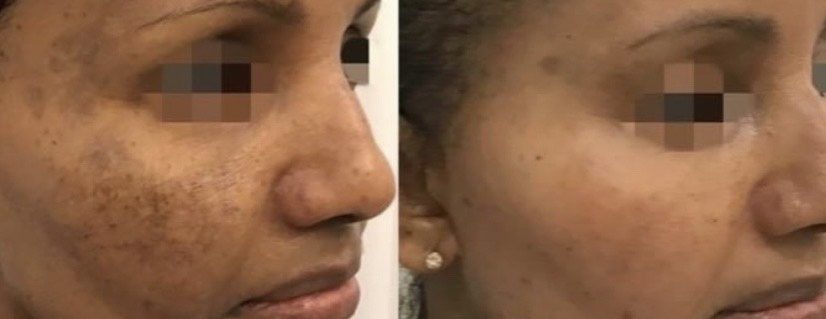 Before and After Cosmelan Pigmentation Treatment