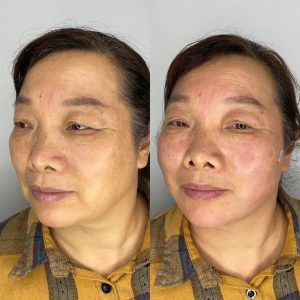 Facial-Rejuvenation-with-Thread-Lifts