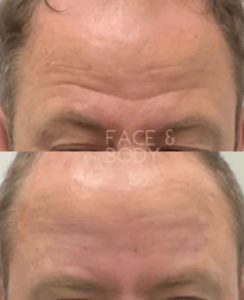 Line-Relaxer-Injectables