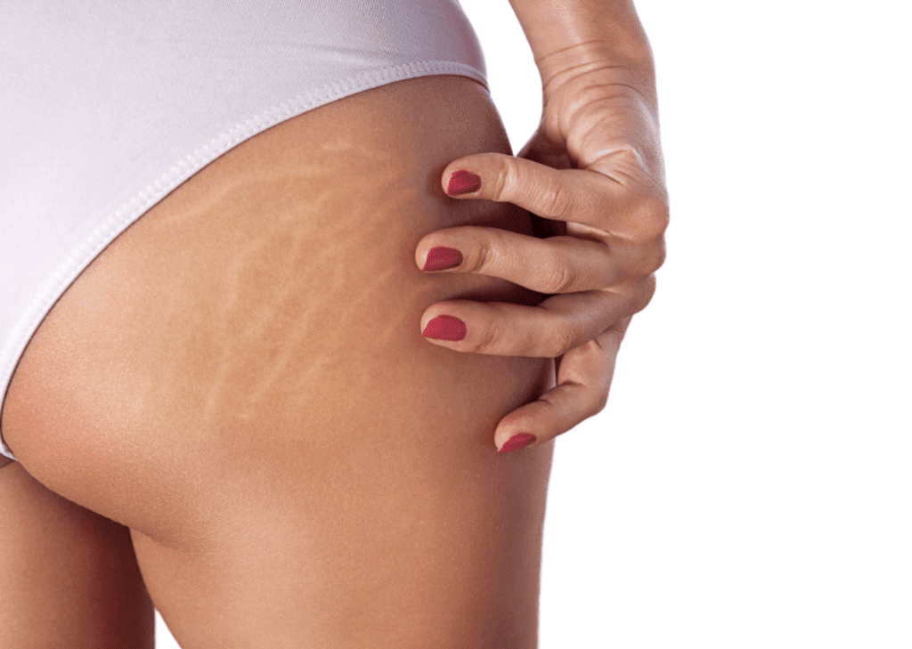 Stretch Mark Treatment in Australia