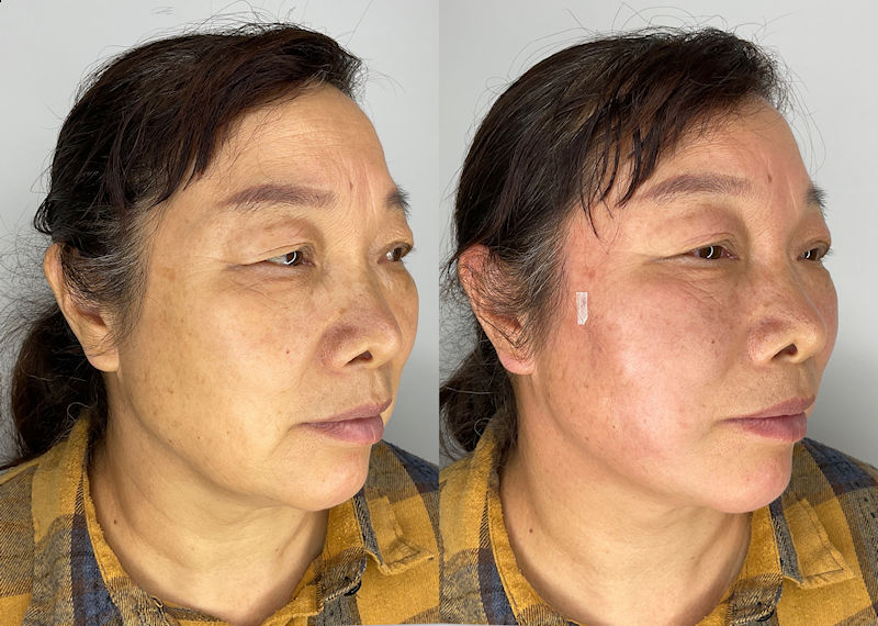 Facial Rejuvenation with Thread Lifts