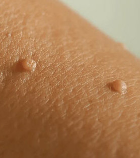 Mole and Skin Tag Removal