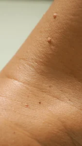 Skin Tag Removal