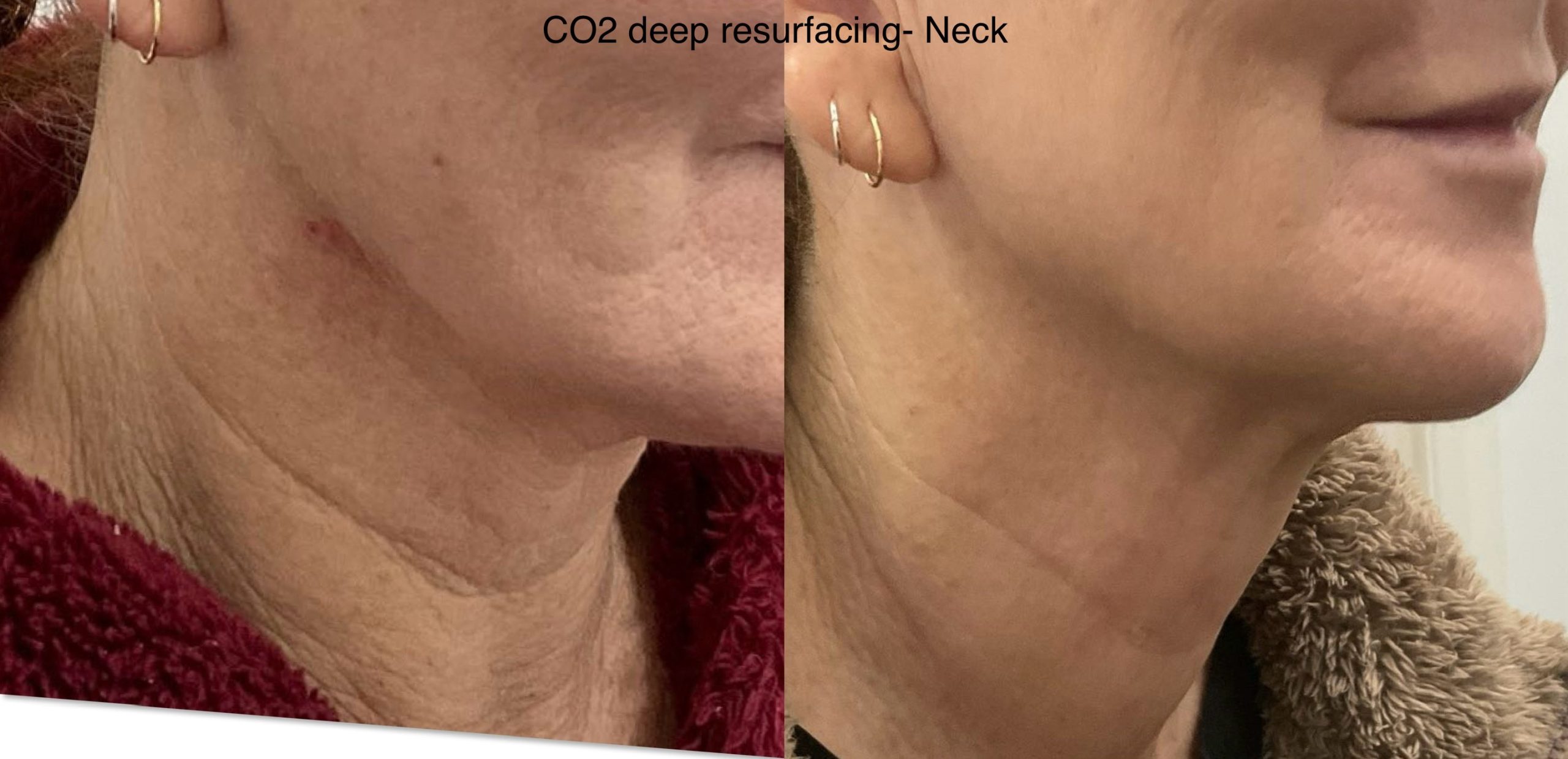Co2 Laser Skin Tightening