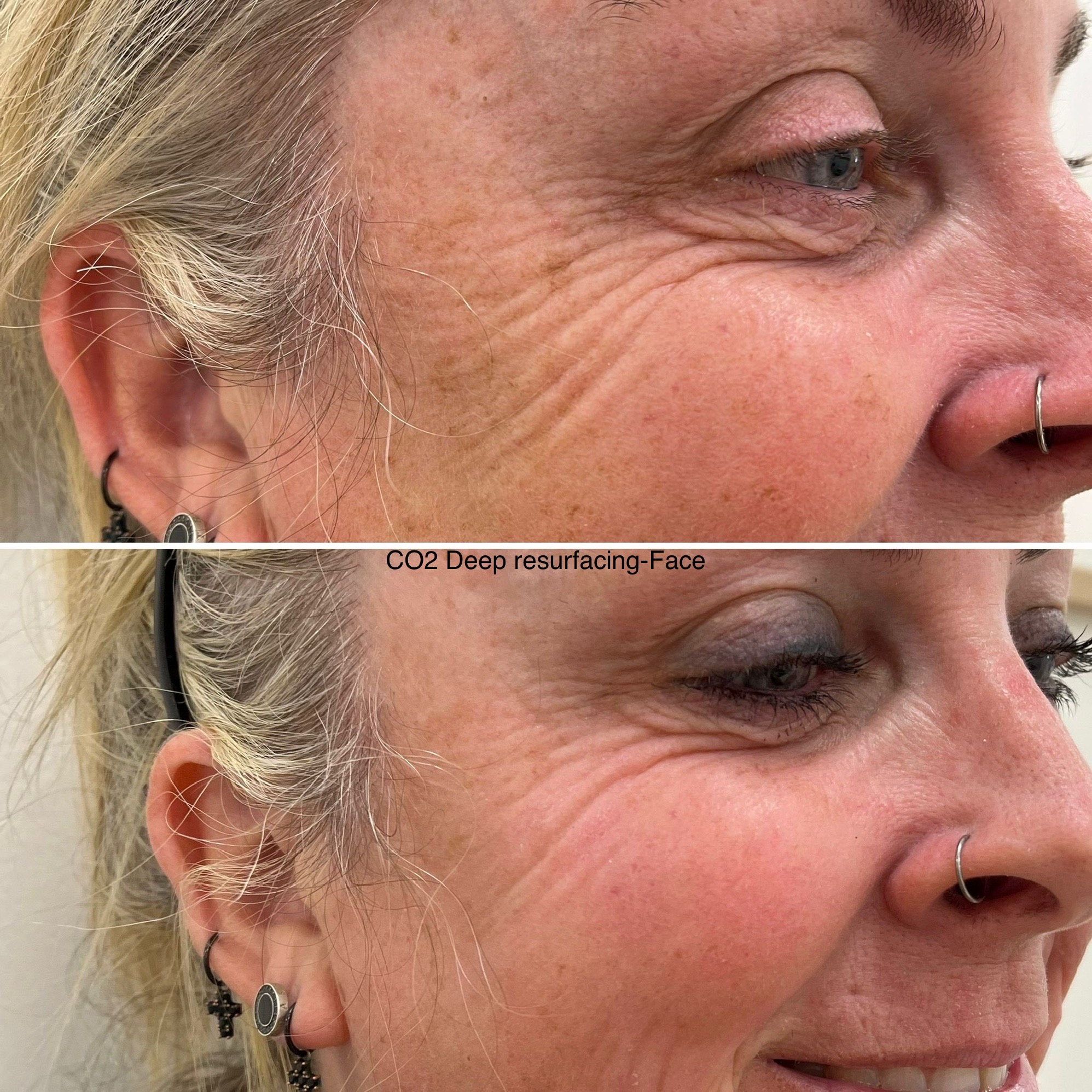 Co2 Laser Skin Tightening