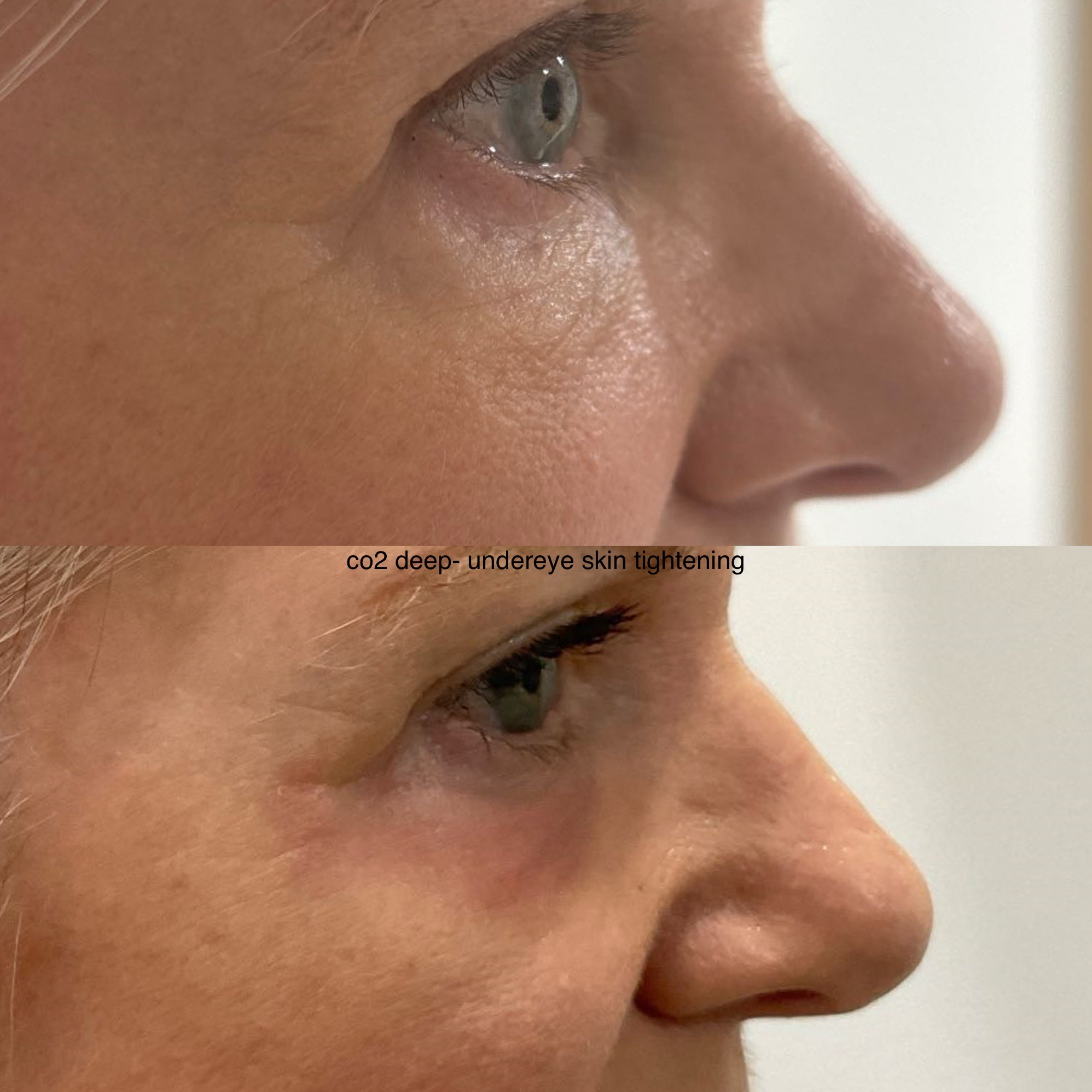 Co2 Laser Skin Tightening