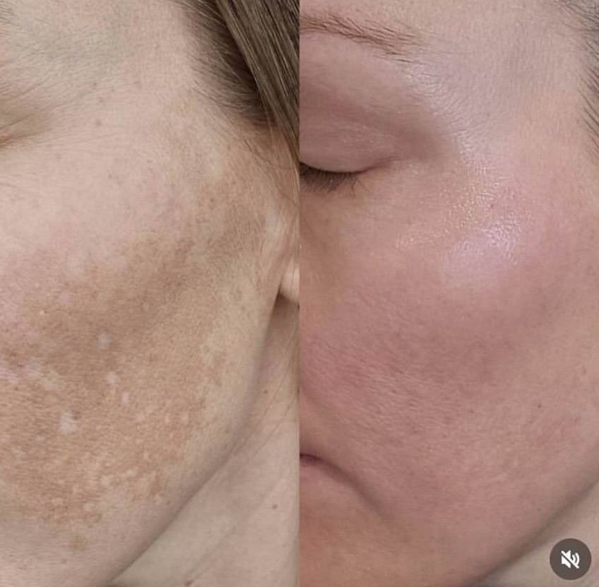 Hyperpigmentation -Age spots Sun Spots Melasma