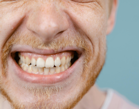 Teeth Clenching