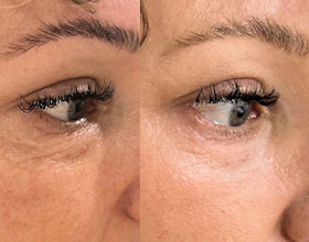 Under Eye Hollow and sagging Eyelids