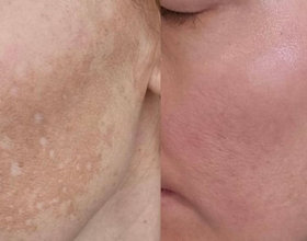 hyperpigmentation