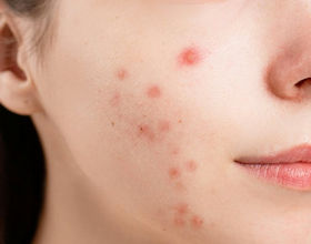 Conditions we treat Acne Scars