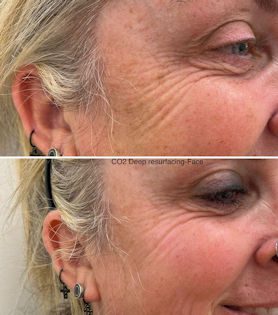 Co2 Laser resurfacing