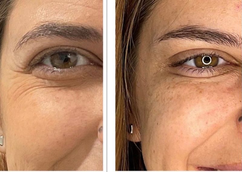 Eyebrow-Lift