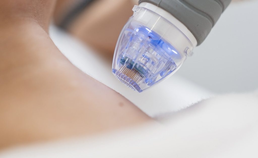 Fractional-RF-Needling