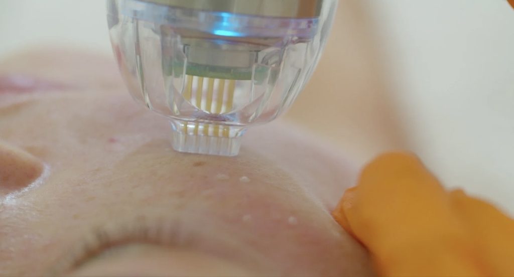 Fractional-RF-Needling