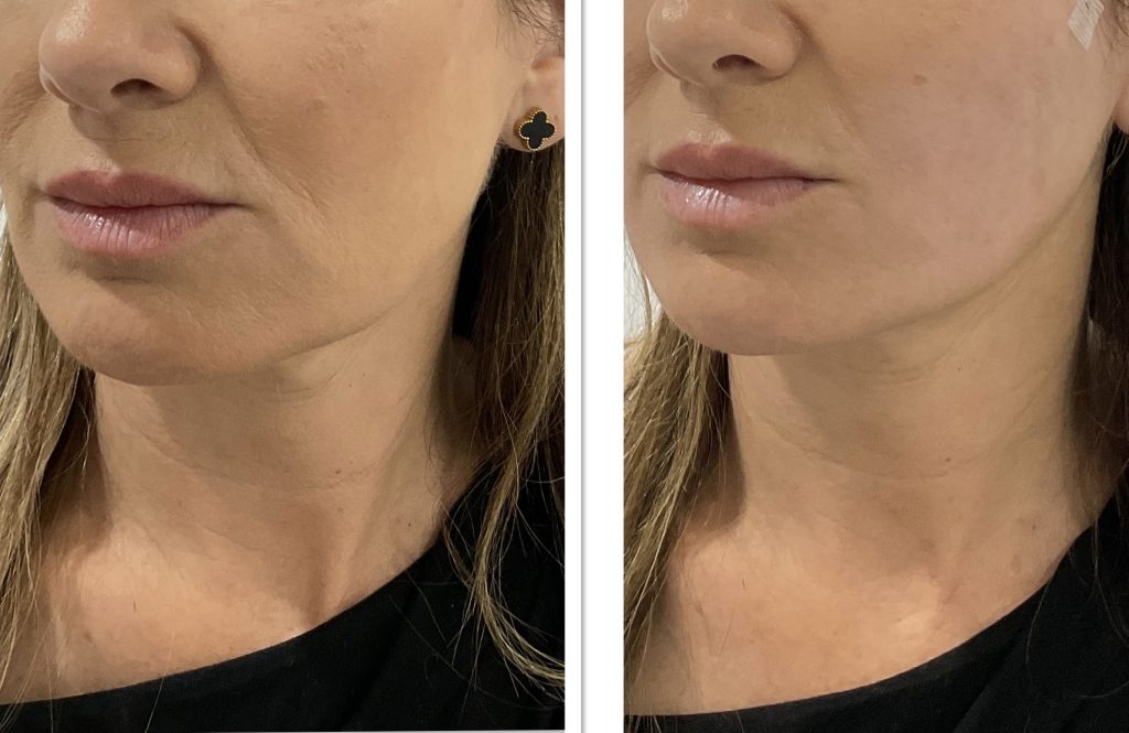 Jowl-Thread-Lift