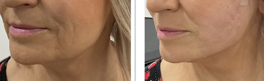 Jowl-Thread-Lift