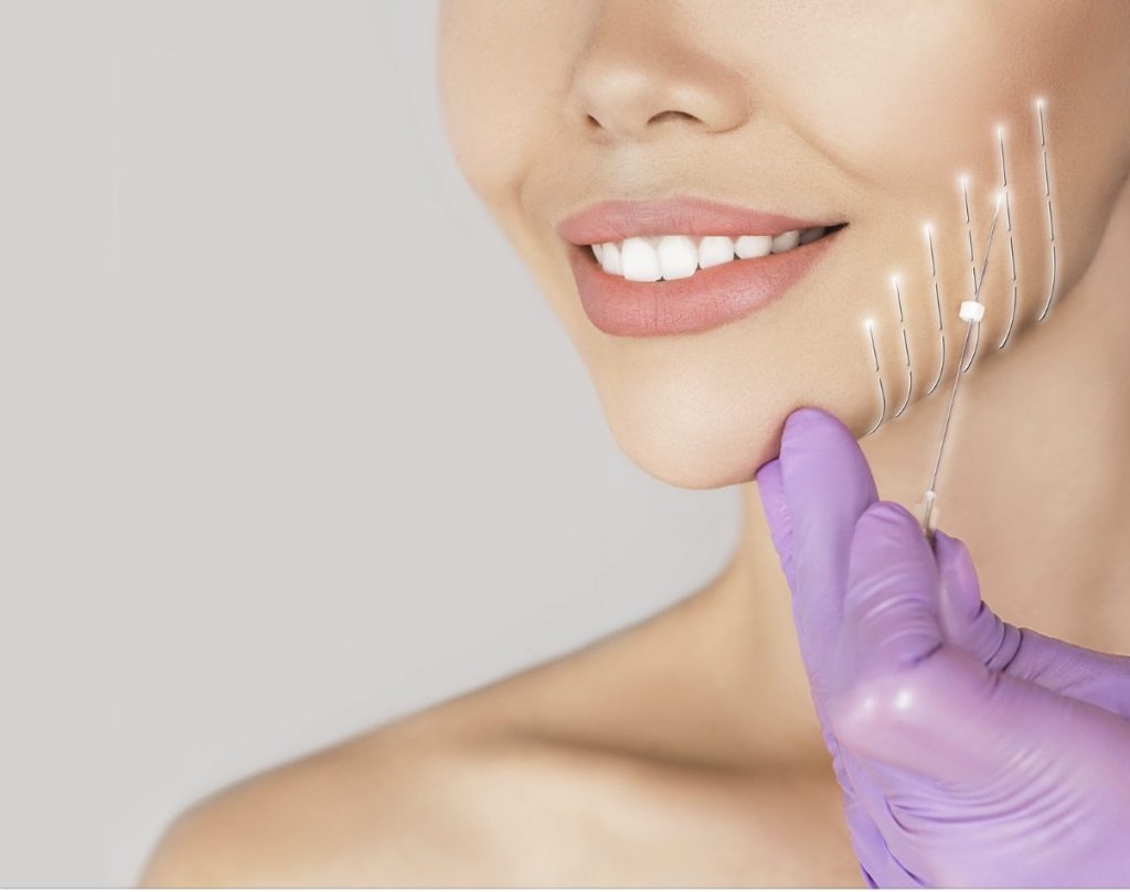 Jowl-Thread-Lift