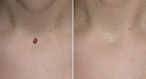 Mole removal skin tag removal