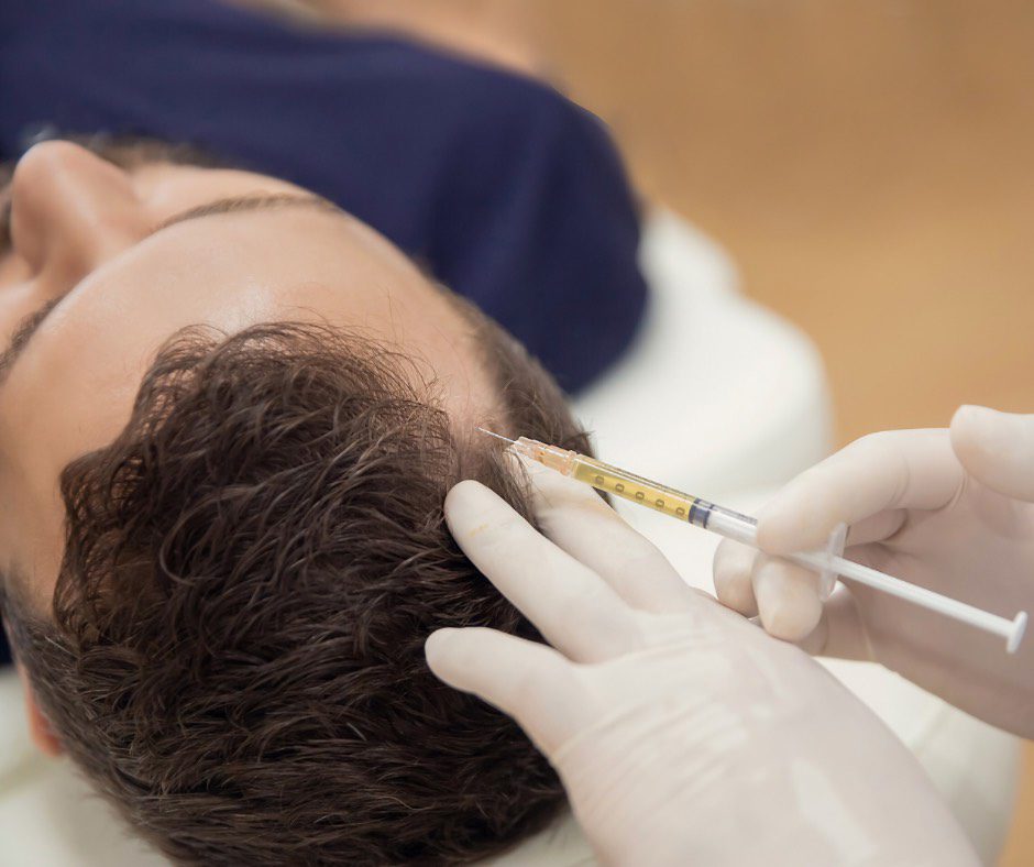 PRP-or-PRF-Hair-Loss-Treatment