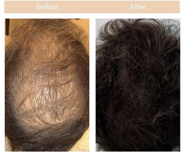 PRP-or-PRF-Hair-Loss-Treatment