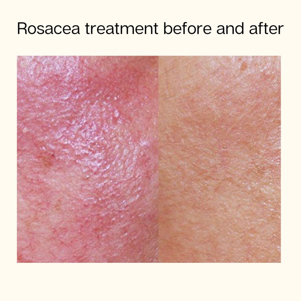 Vascular Rocacea Laser Vascular Removal for unwanted Capillaries, Veins, Redness or ...