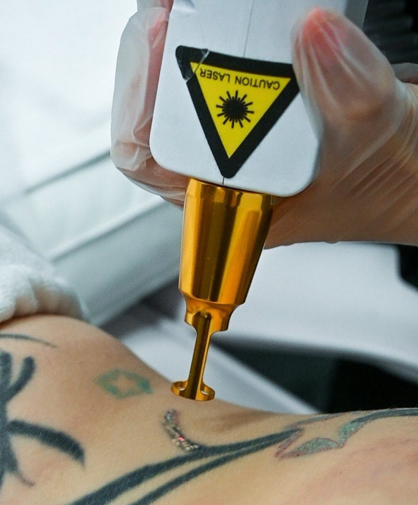Tattoo-removal-laser