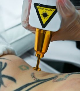 Tattoo removal laser