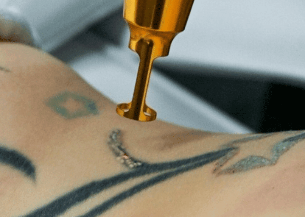 Tattoos and Tattoo Removal in Australia